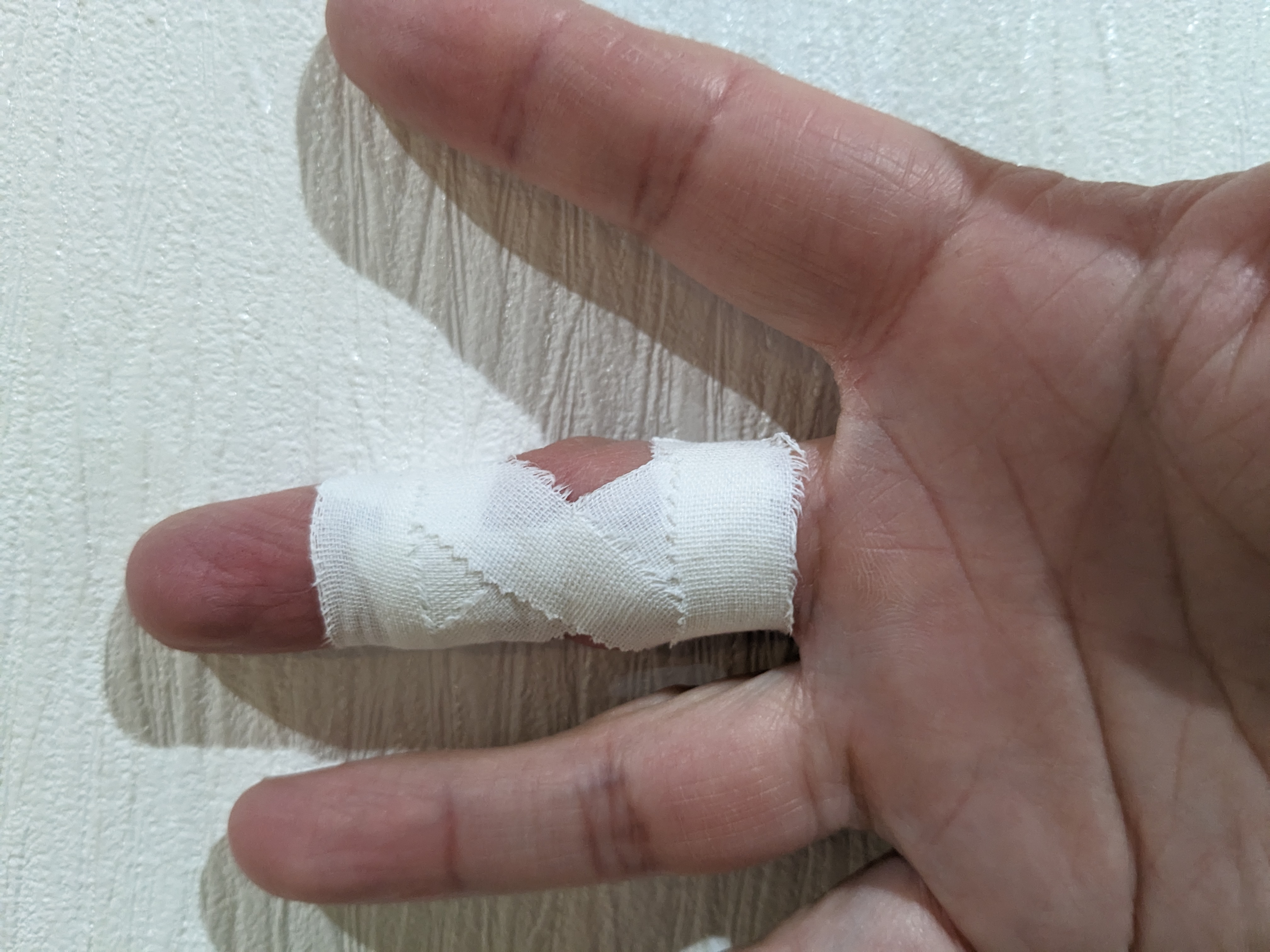 接骨院での指の痛み治療